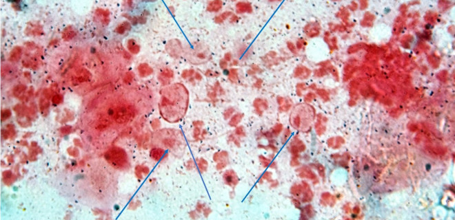 Trichomonas