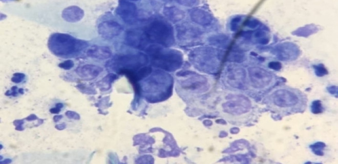 Chlamydia